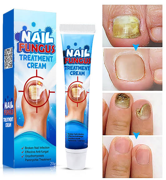 كريم علاج فطريات الأظافر (Nail Fungus Treatment Cream)